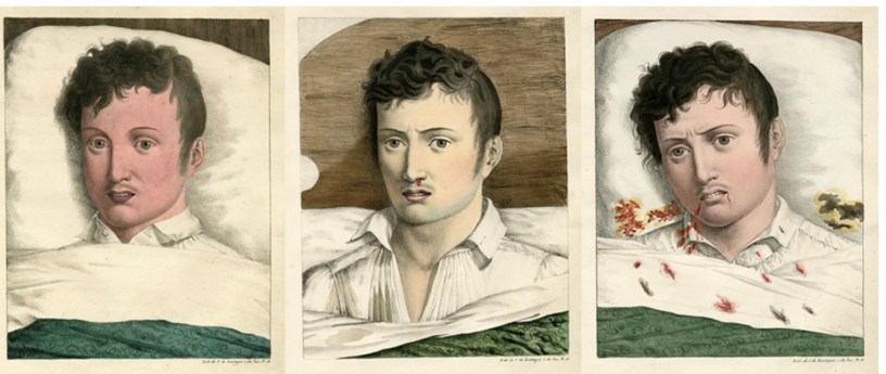 Yellow Fever, Philadelphia